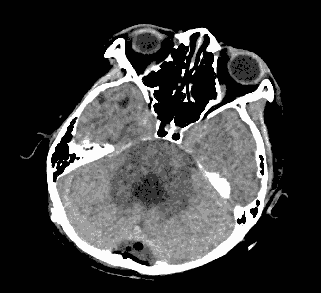 post-ax-ct